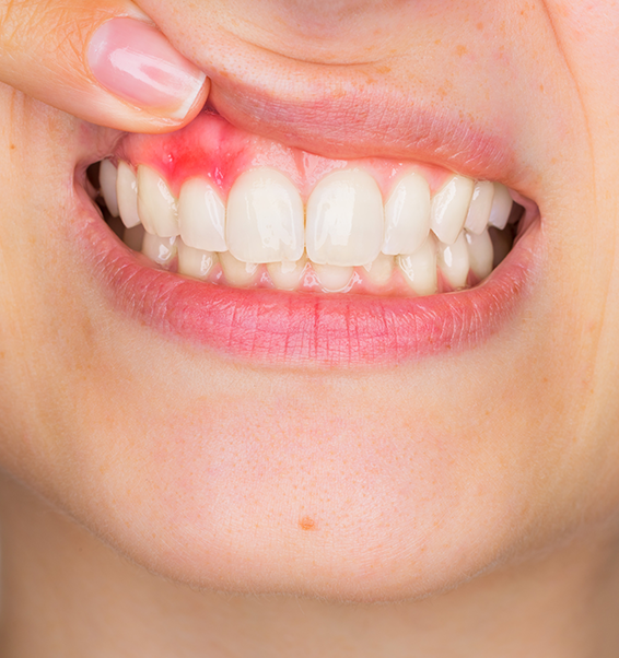Abscess in Mouth Treatment at Smile Clinic London