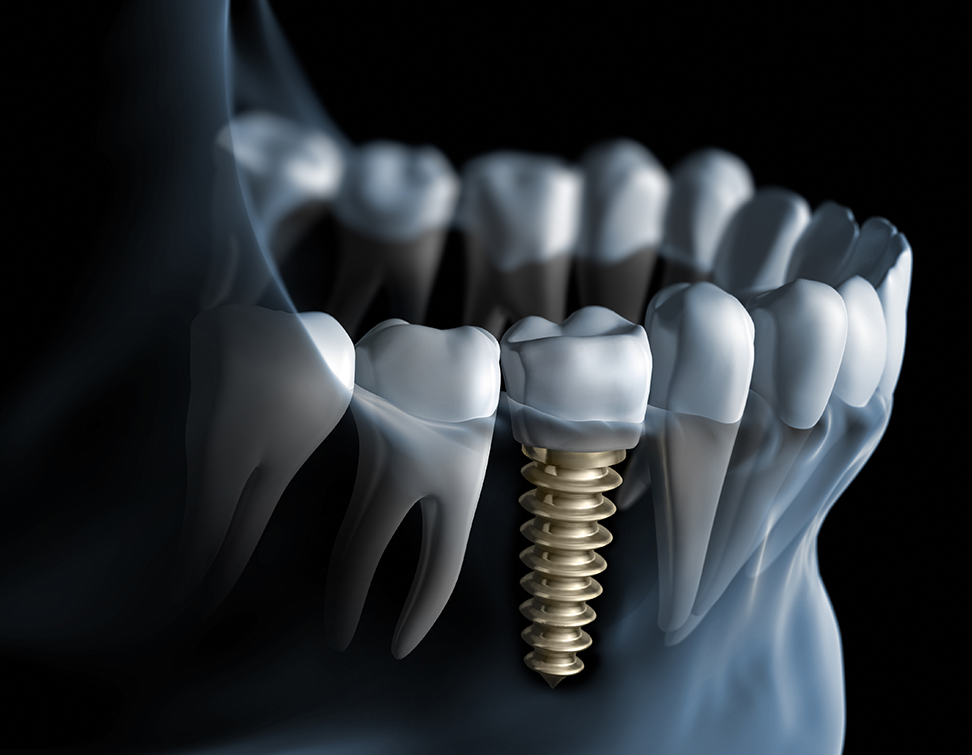 Affordable Dental implant in London, UK