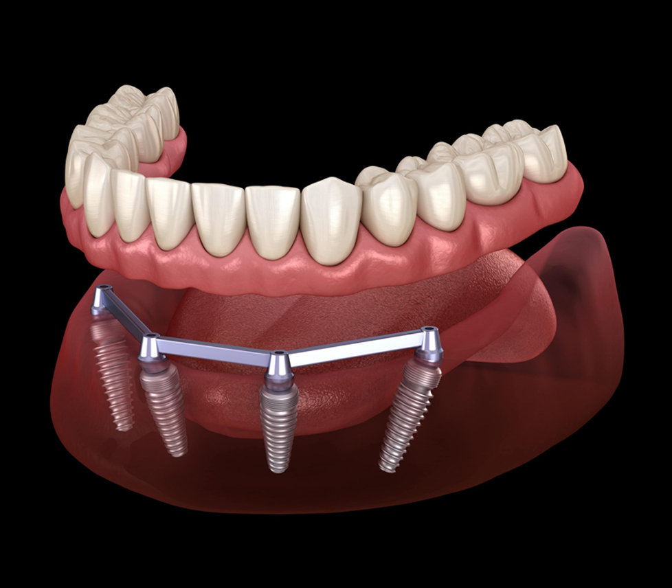 All on 4 Dental implants cost in London