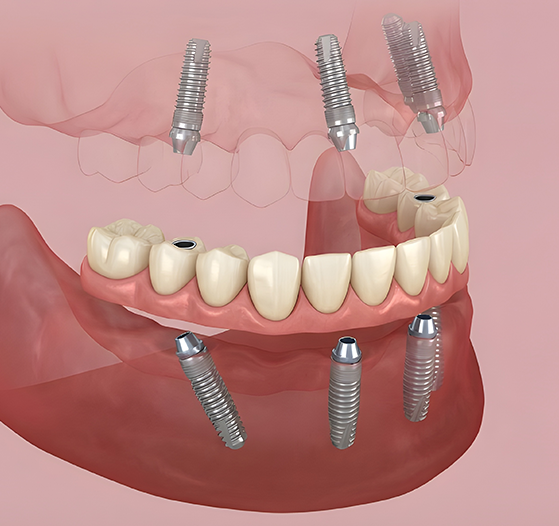 All on 4 Dental Implants in London