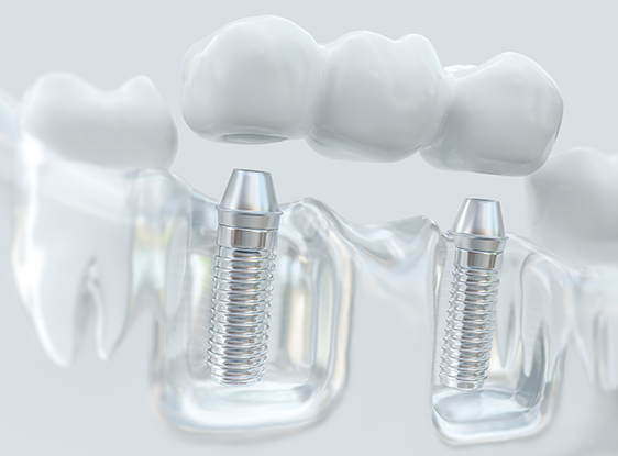 Alternatives to dental bridges - Smile Clinic London