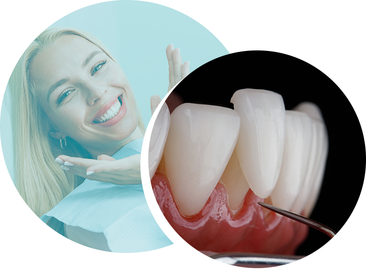 Average cost of Veneers in London, UK