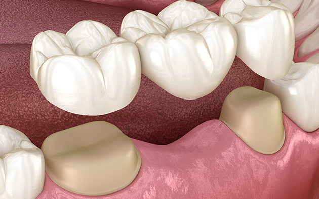 Dental Bridges treatment in London
