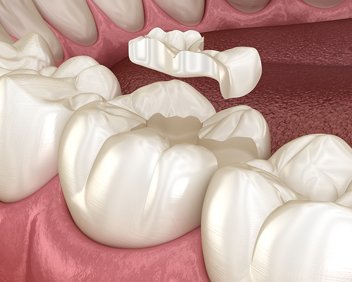 Inlays and Onlays Treatment in London