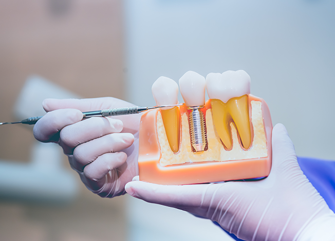 Best London Dental Crown – Smile Clinic London