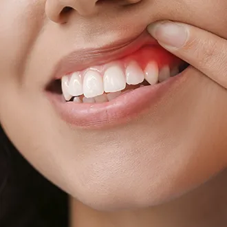 Bleaching and Whiting Stained Teeth Services in London.