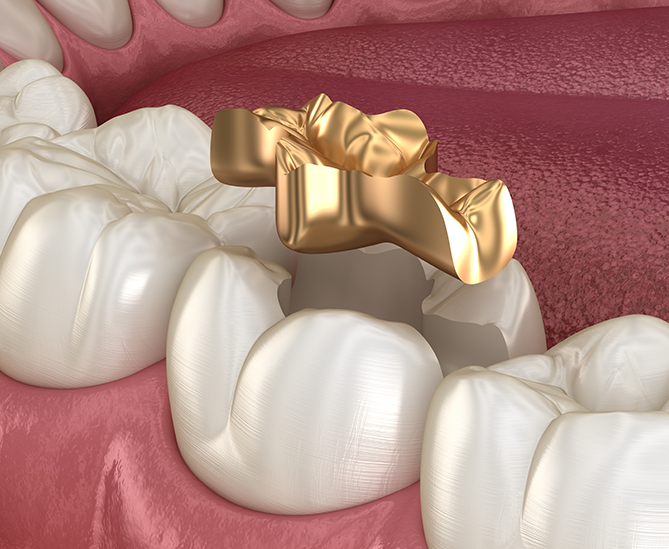 Aftercare for Dental Inlays and Onlays Treatment - Smile Clinic London