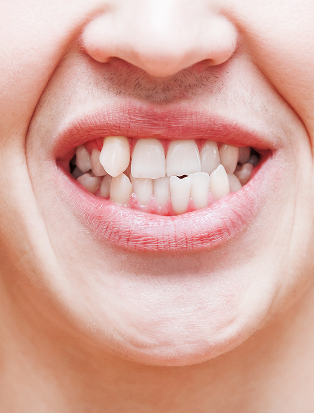 Causes for Crooked Teeth - Smile Clinic London