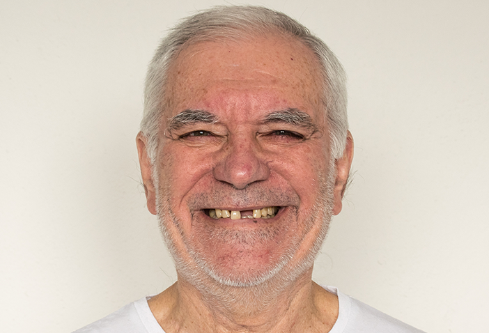 Chipped Teeth Repair Treatment in London