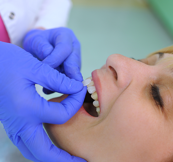 Composite Veneers price in London