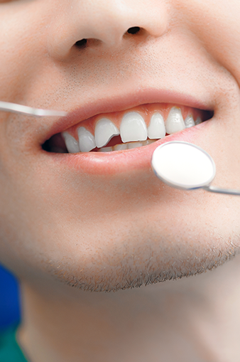 Cracked Tooth Treatment in Lonodn.