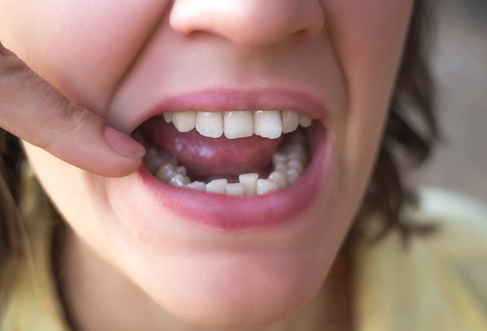 Crooked Teeth Treatment in London
