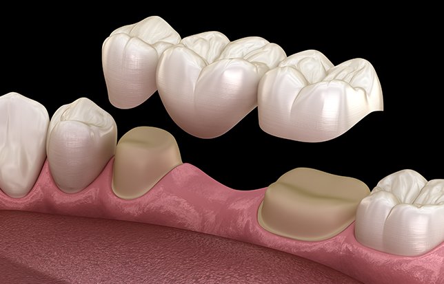 Dental Bridges treatment procedure at Smile Clinic London