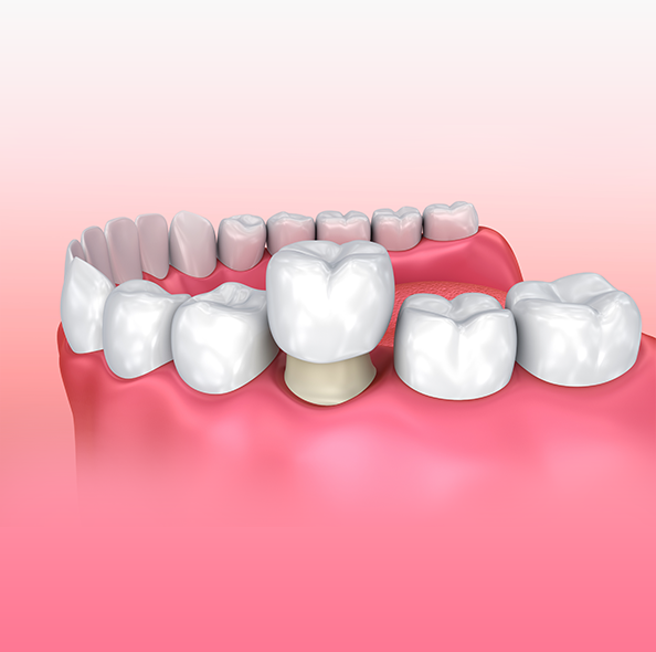 Dental Crowns in London