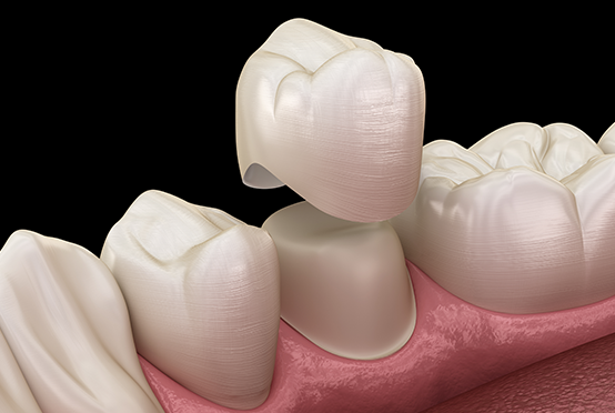Dental Crown price in UK – Smile Clinic London