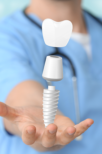 Dental Implants in London