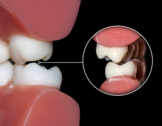 Dental Bruxism Treatment in London