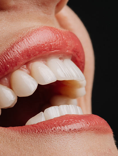 Dental Veneers London