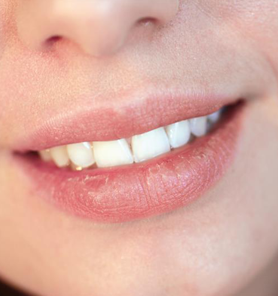 Dry Mouth Remedies in London - Smile Clinic London