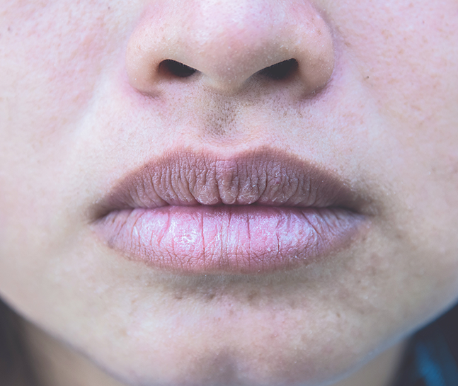 Dry Mouth Treatment in London - Smile Clinic London