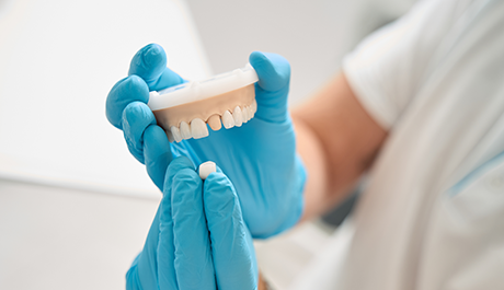 Emax Veneers in London
