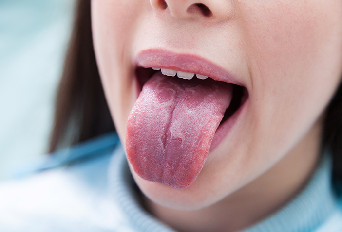 Geographic Tongue Treatment in London – Smile Clinic London