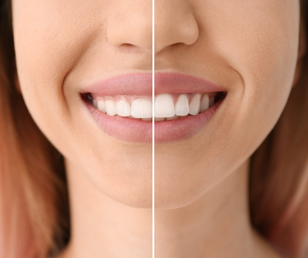 Gum Contouring Price in the UK