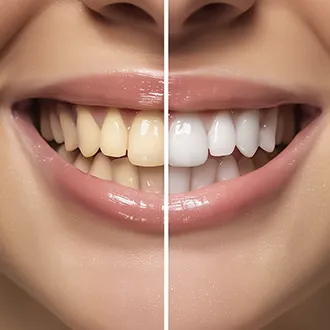 Gum Disease Treatment at Smile Clinic London.