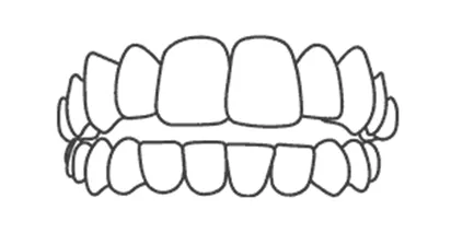 Invisalign for Open bite Teeth