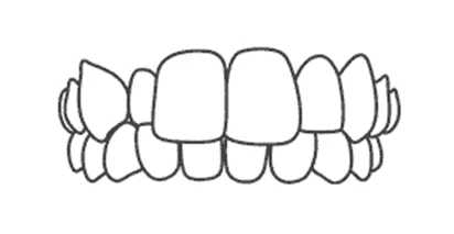 Invisalign for Crossbite Teeth