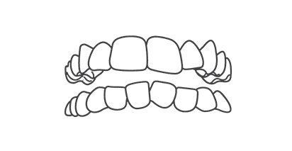 Invisalign for Crowded Teeth