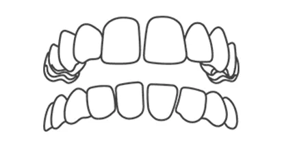 Invisalign for Gapped Teeth