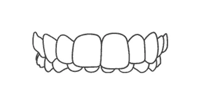 Invisalign for Overbite Teeth