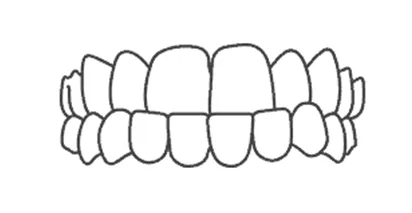 Invisalign for Underbite Teeth