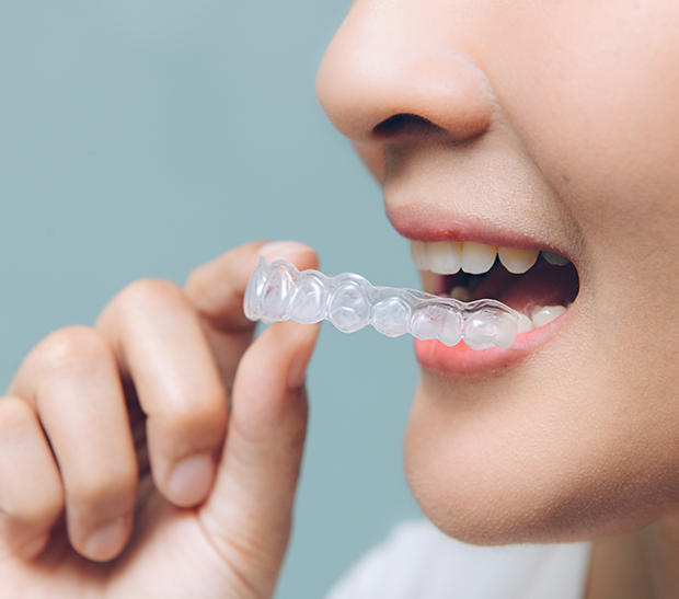Invisalign Prices and finance options in UK