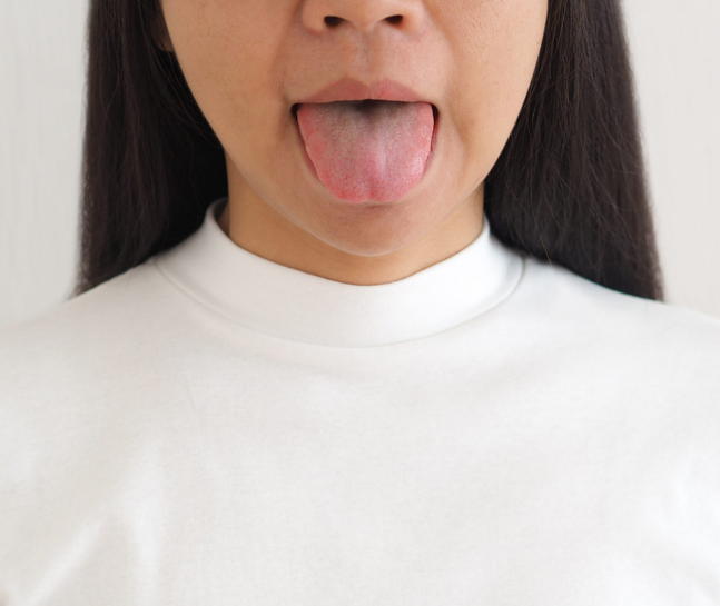 Lichen planus Treatment in London - Smile Clinic London