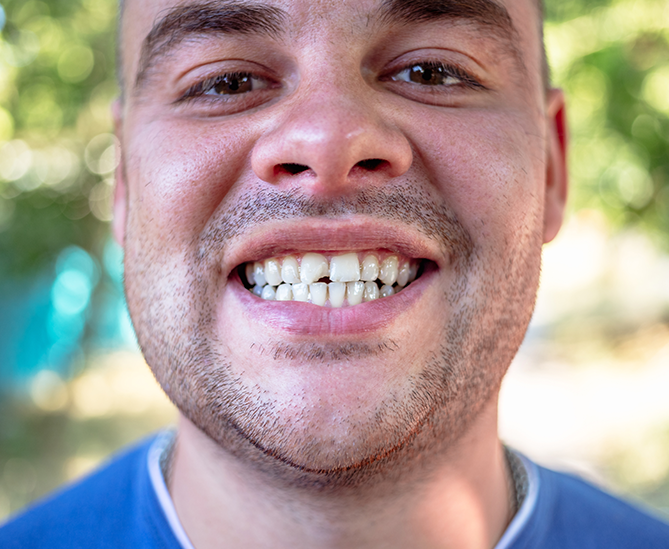 Chipped Tooth Repair Appointment at Smile Clinic London
