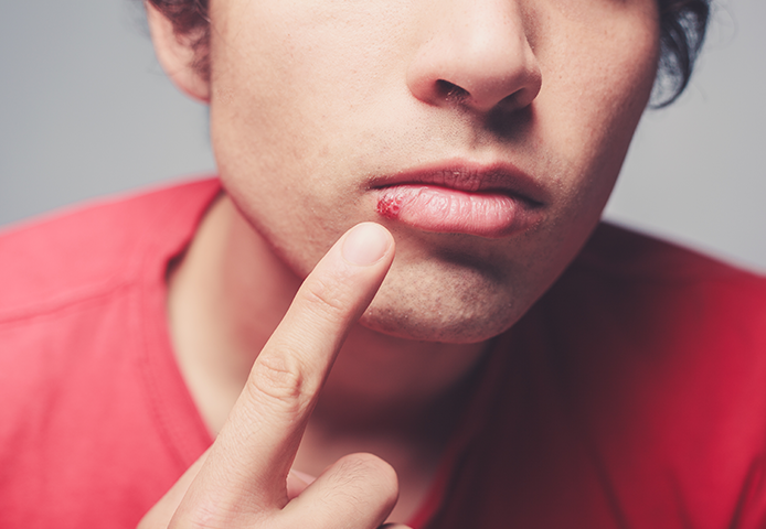 Mouth Sores Causes and Treatment