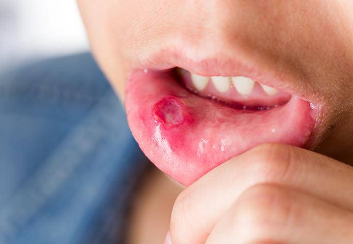 Mouth Ulcer Treatment at Smile Clinic London