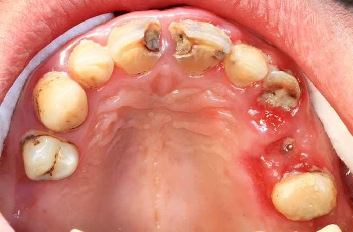 Oral Cancer Surgery at Smile Clinic London