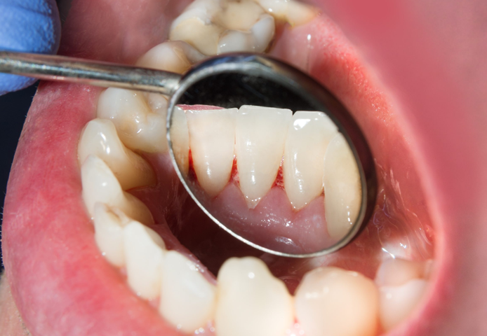 Oral Cancer Treatment in London