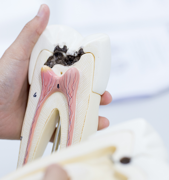Dental Decay Treatment Appointment at Smile Clinic London