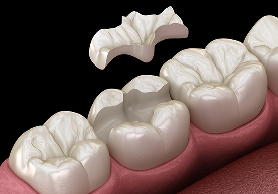 Dental Inlay and Onlay Procedure - Smile Clinic London