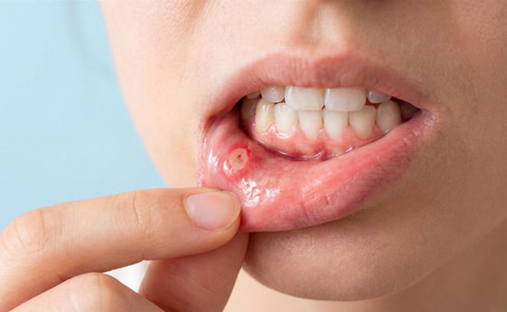 Professional Mouth Sores Treatment in London
