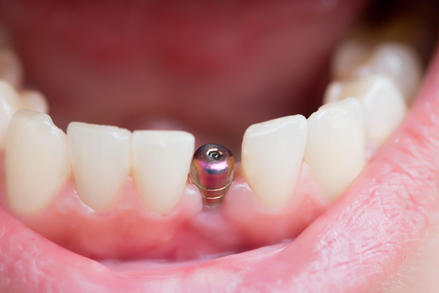 Single tooth implant price in London