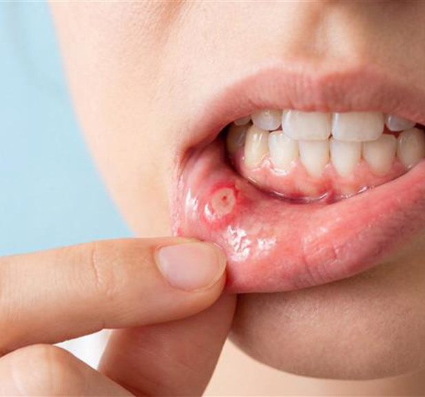 Sores in Mouth - Symptoms of Mouth Ulcers