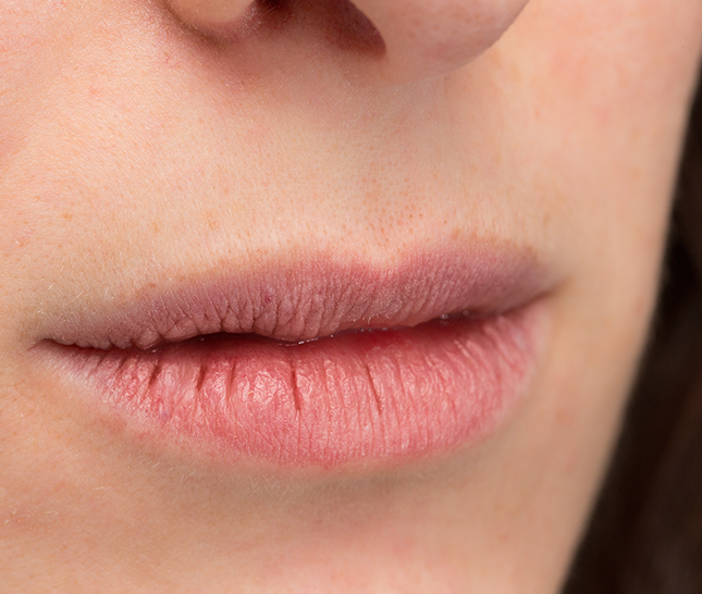 symptoms of dry mouth - Smile Clinic London