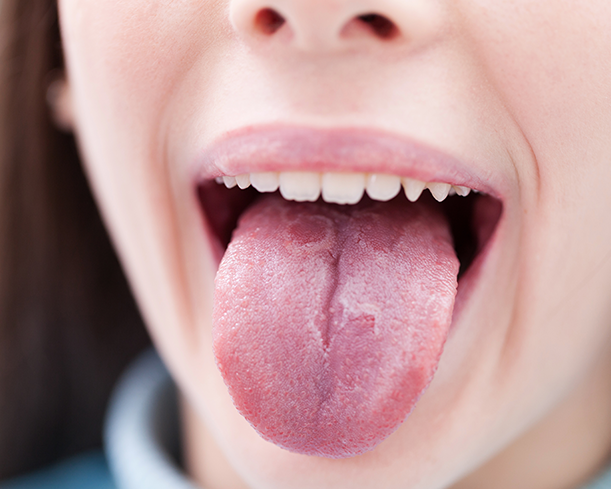 Symptoms of Geographic Tongue in London