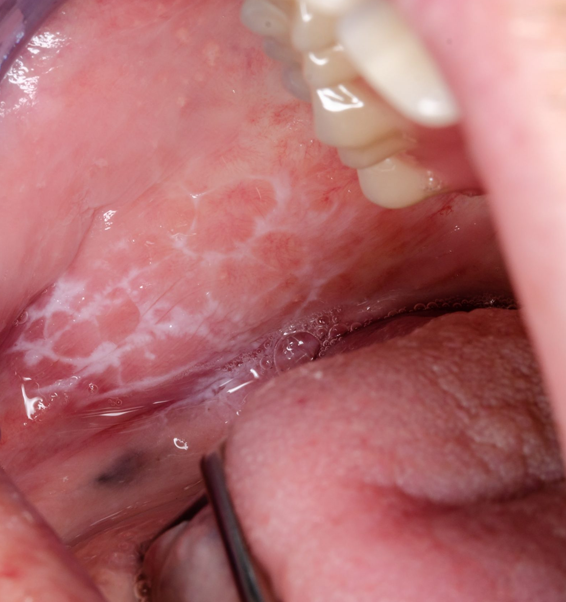 Lichen Planus Symptoms in London