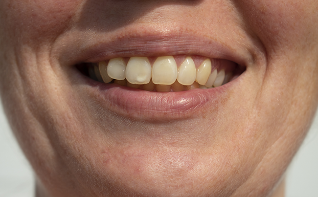 Teeth-stained removal dentist – Smile Clinic London